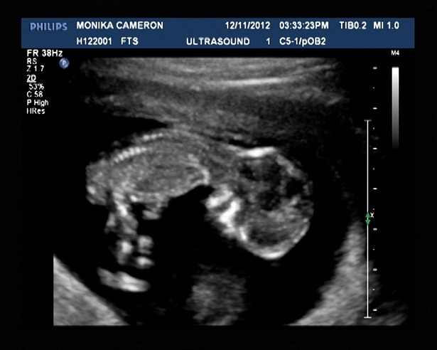 Butterbomb Baby 3 at 12 Week Scan